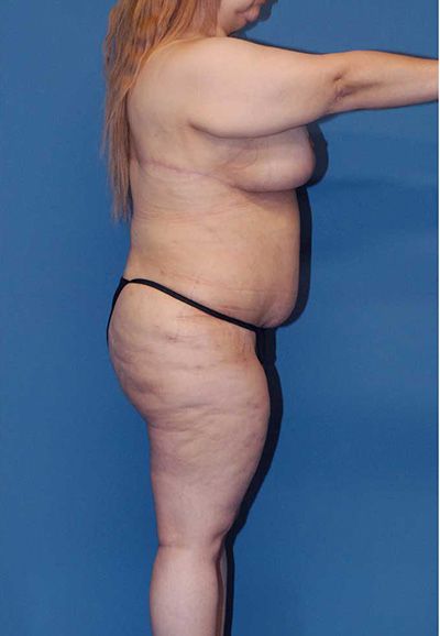 Brazilian Butt Lift Before & After