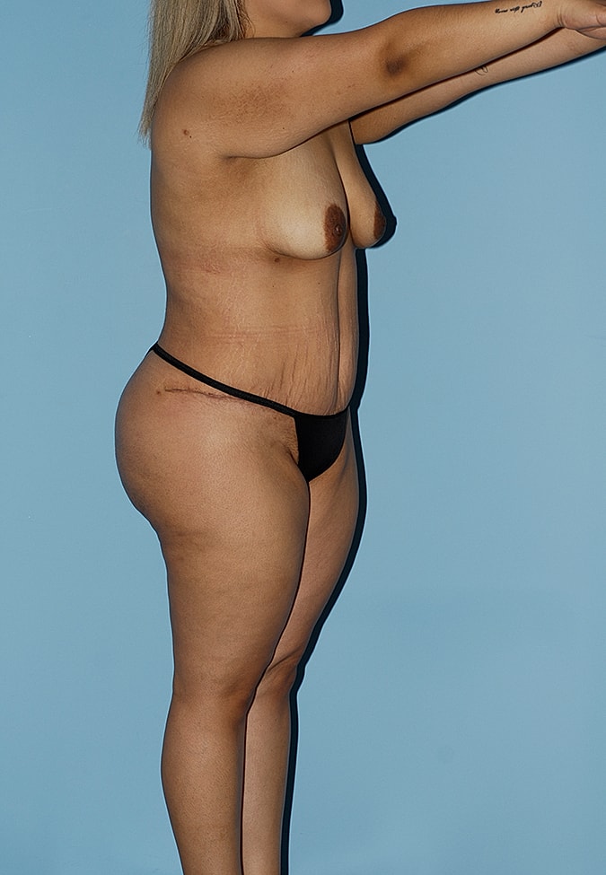 Brazilian Butt Lift Before & After