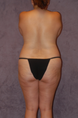 Brazilian Butt Lift Before & After