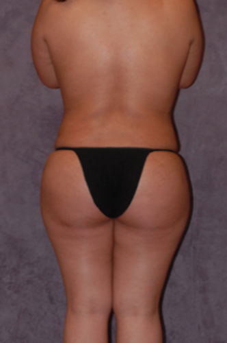 Brazilian Butt Lift Before & After
