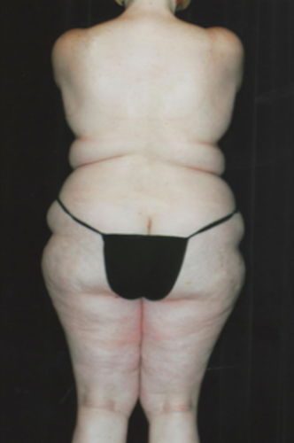 Brazilian Butt Lift Before & After