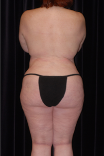 Brazilian Butt Lift Before & After