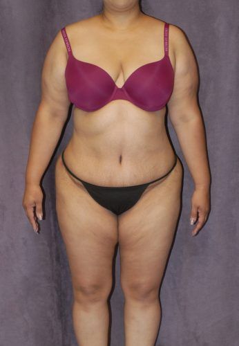 Brazilian Butt Lift Before & After