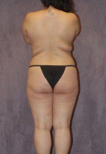 Brazilian Butt Lift Before & After