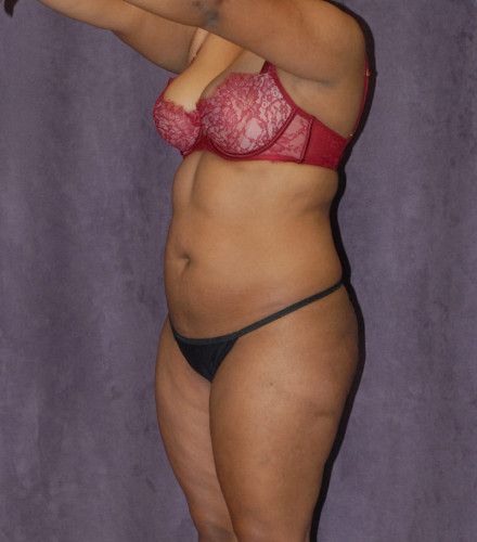 Brazilian Butt Lift Before & After