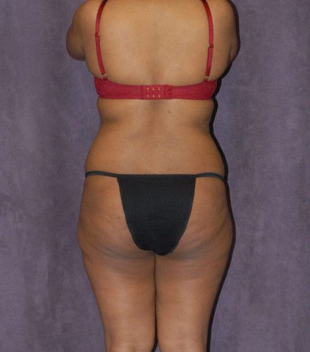 Brazilian Butt Lift Before & After