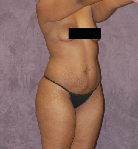Brazilian Butt Lift Before & After