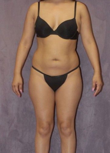 Brazilian Butt Lift Before & After