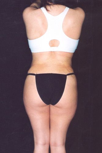 Brazilian Butt Lift Before & After