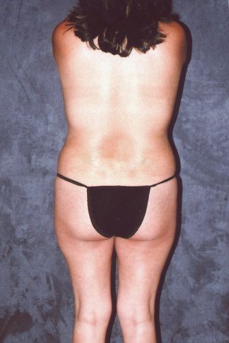 Brazilian Butt Lift Before & After