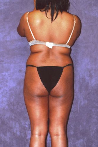 Brazilian Butt Lift Before & After