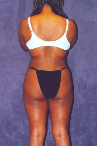 Brazilian Butt Lift Before & After