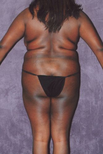 Brazilian Butt Lift Before & After