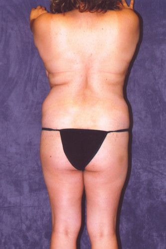 Brazilian Butt Lift Before & After