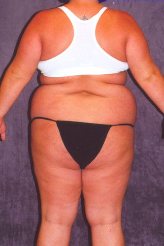 Brazilian Butt Lift Before & After