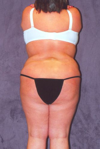 Brazilian Butt Lift Before & After