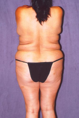 Brazilian Butt Lift Before & After