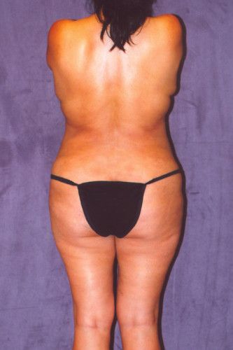 Brazilian Butt Lift Before & After