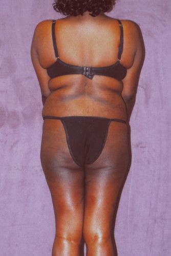 Brazilian Butt Lift Before & After