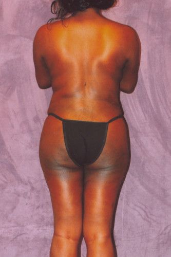 Brazilian Butt Lift Before & After