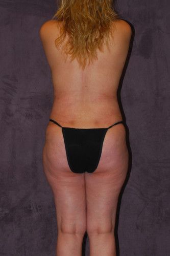 Brazilian Butt Lift Before & After