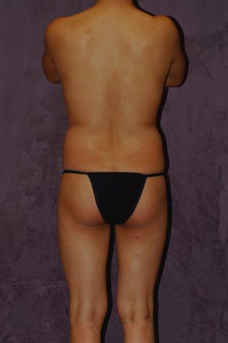 Brazilian Butt Lift Before & After