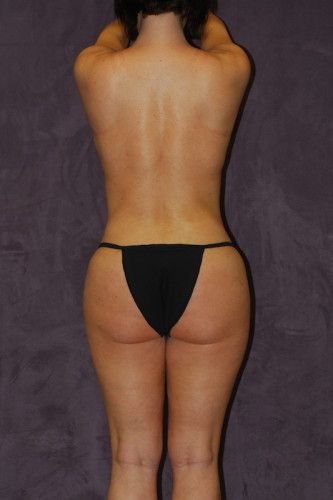 Brazilian Butt Lift Before & After
