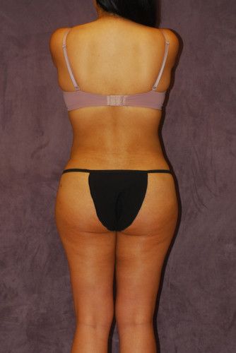 Brazilian Butt Lift Before & After