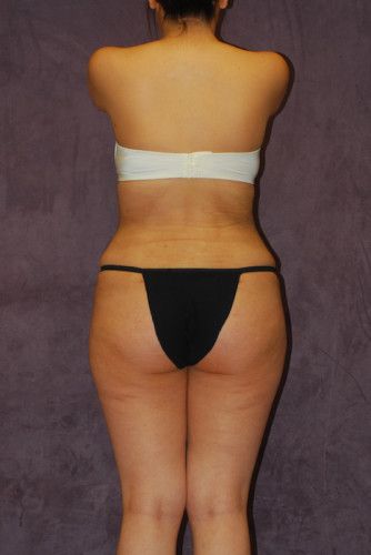 Brazilian Butt Lift Before & After