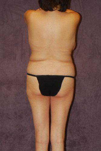 Brazilian Butt Lift Before & After