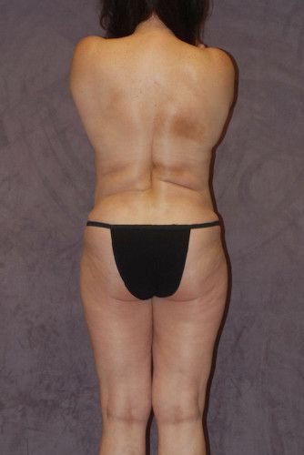 Brazilian Butt Lift Before & After
