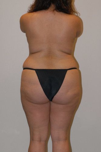 Brazilian Butt Lift Before & After