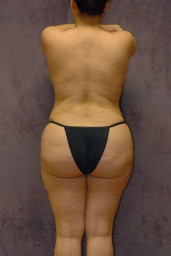Brazilian Butt Lift Before & After