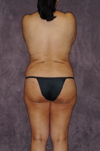 Brazilian Butt Lift Before & After