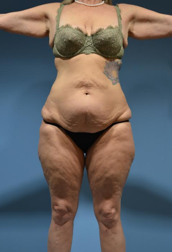 Brazilian Butt Lift Before & After