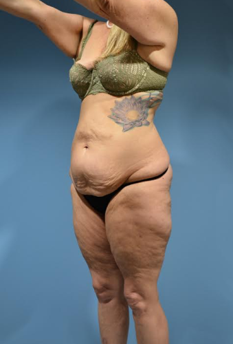 Brazilian Butt Lift Before & After