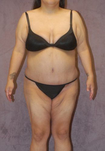 Brazilian Butt Lift Before & After