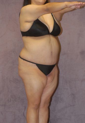 Brazilian Butt Lift Before & After