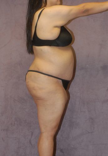 Brazilian Butt Lift Before & After