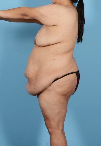 Brazilian Butt Lift Before & After