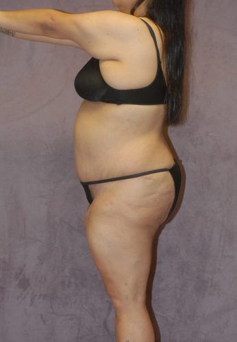 Brazilian Butt Lift Before & After