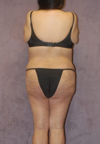 Brazilian Butt Lift Before & After
