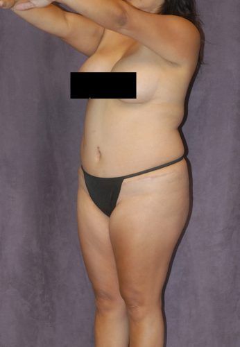 Brazilian Butt Lift Before & After