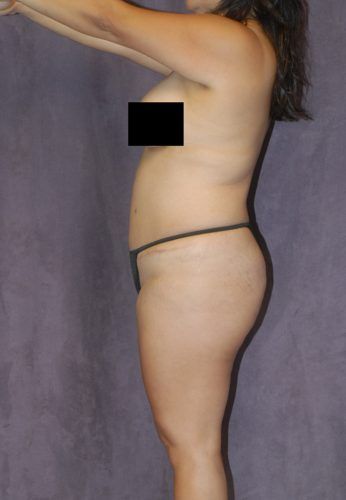 Brazilian Butt Lift Before & After