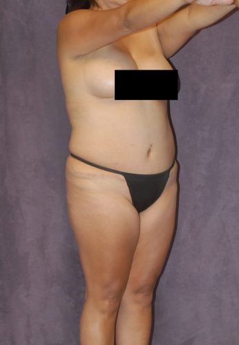 Brazilian Butt Lift Before & After