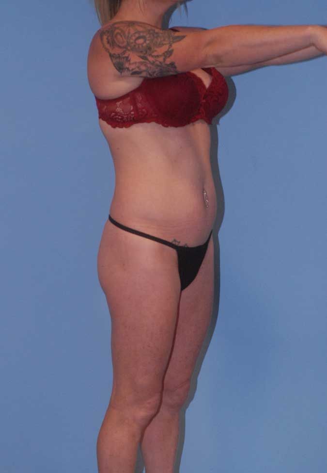 Brazilian Butt Lift Before & After