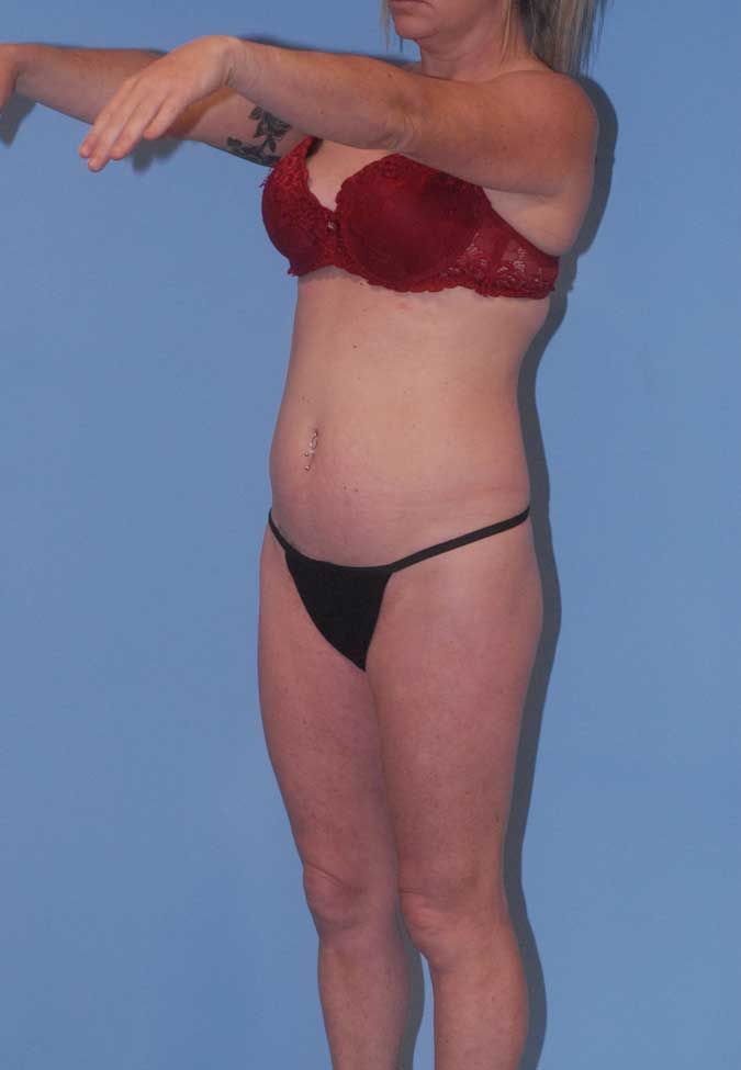 Brazilian Butt Lift Before & After