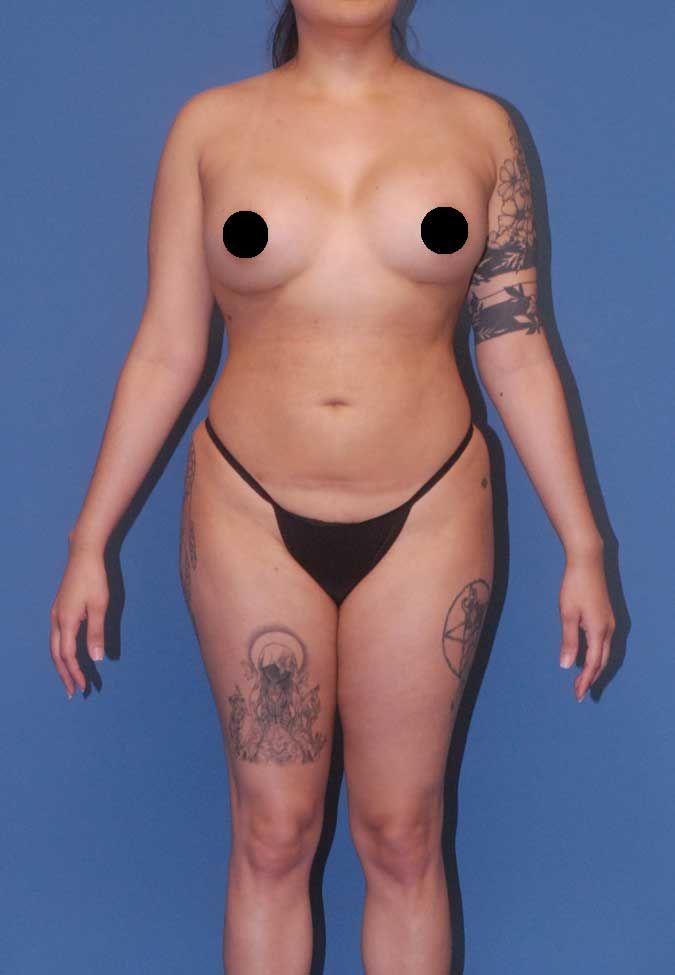 Brazilian Butt Lift Before & After