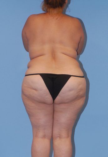 Brazilian Butt Lift Before & After