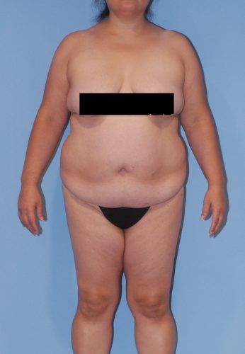 Brazilian Butt Lift Before & After